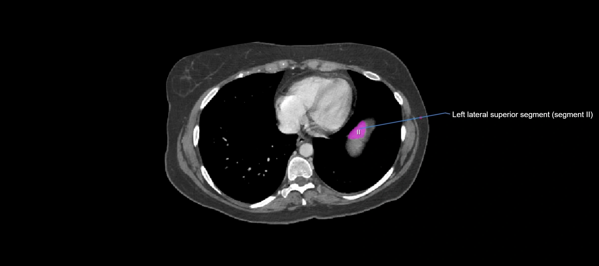 CT liver segments axial cross sectional anatomy labelled image-00080.webp